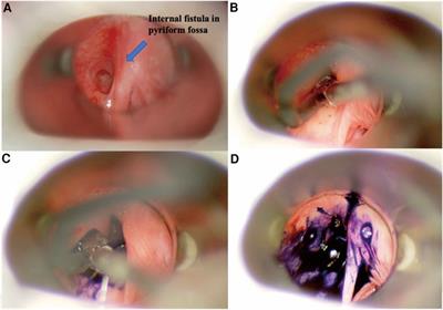 A novel and efficient surgical procedure for pyriform sinus fistulas in children
